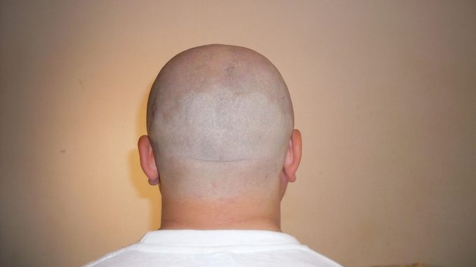 The back of the head of a male with no hair, in an undated photo. New research into factors that control the life and death of hair follicle cells could help people with baldness, as well as wound healing, according to researchers from the University of California, Riverside in CA, USA. (Helpaeatcontu/Zenger)