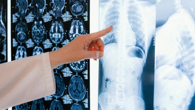 AI technology could play a crucial role in identifying non-smokers at risk of developing lung cancer. ANNA SHVETS/PEXELS