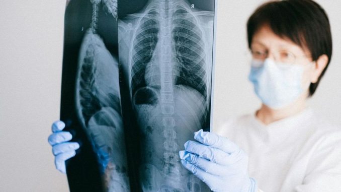 Photo of lung scan. Novel antibody may be key to better lung cancer treatment. ANNA SHVETS VIA PEXELS.