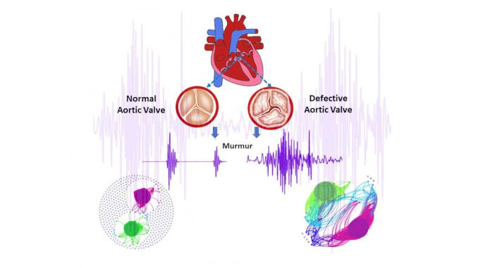A normal aortic valve (left) versus a defective aortic valve (right) and their different sound signals (purple), pictured in an undated photo illustration. The sound data was used to generate graphs at the bottom corners, which differ greatly and can help diagnose aortic valve stenosis. (M.S. Swapna,SWNS/Zenger)